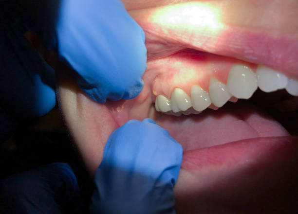 Best Emergency Dentist for Lost Fillings or Crowns in Cedar City, UT